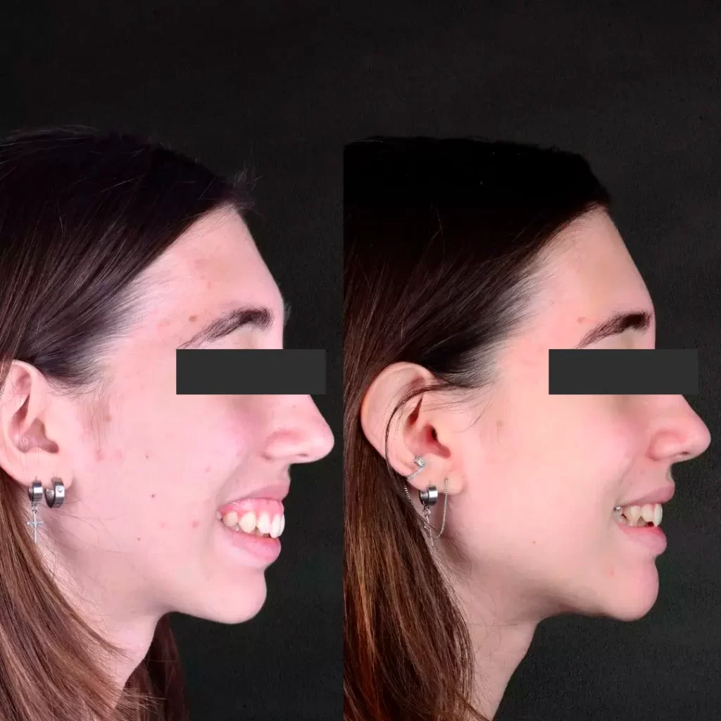 cirurgia-ortognatica-sorriso-gengival